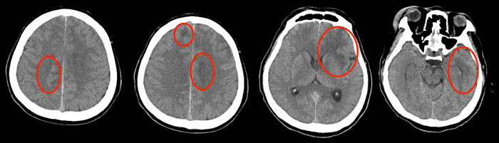 症例5：診断と解説