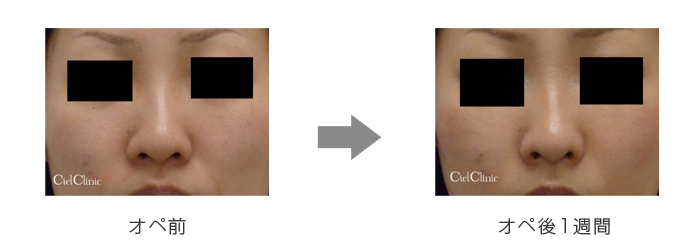 鼻幅縮小(鼻翼基部切除フラップ法) | 六本木 シエルクリニック【公式