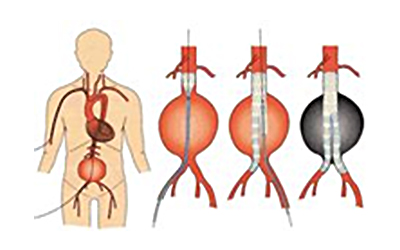 腹部・胸部大動脈瘤治療 | 沖縄 病院 | 医療法人 徳洲会 中部徳洲会病院