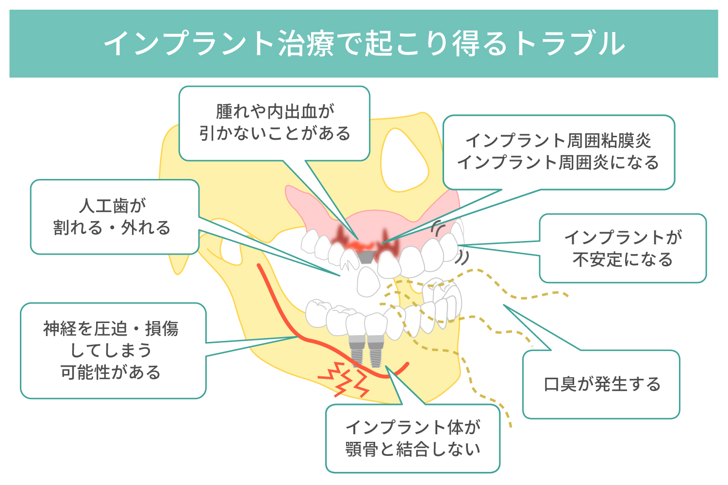 インプラント治療のメリット・デメリット、起こり得るトラブルについて