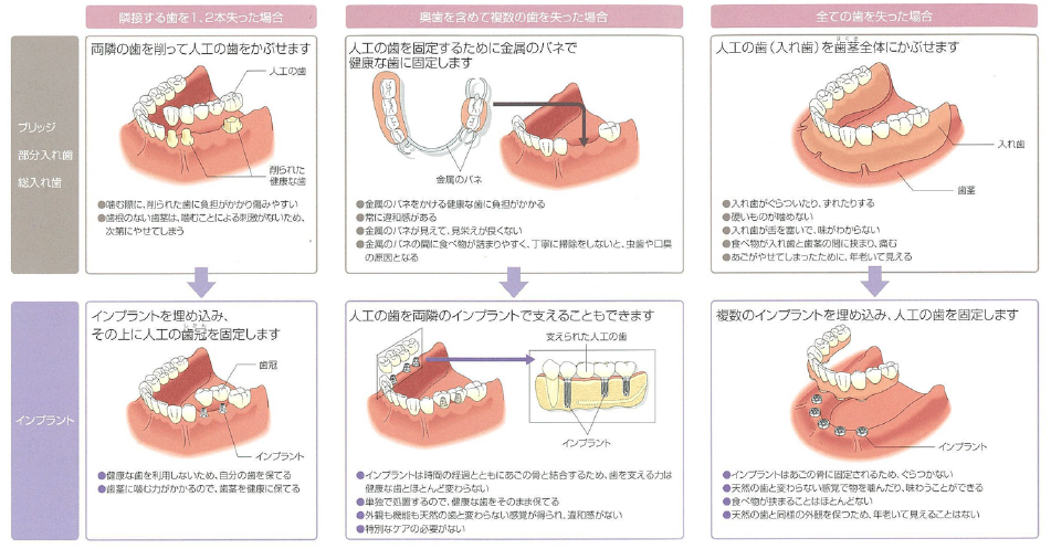 インプラント審美修復｜たかむら歯科・小児歯科武