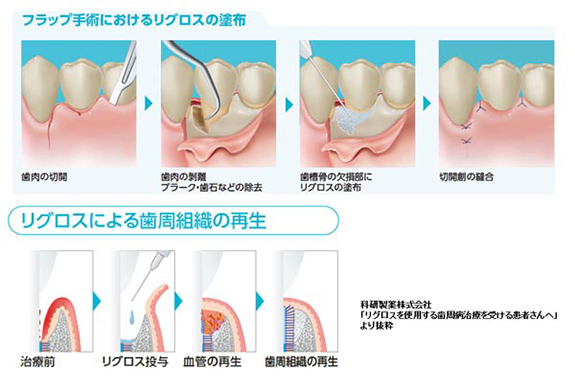 歯周病で失われた歯周組織の再生治療とは？治療別のメリットを解説し
