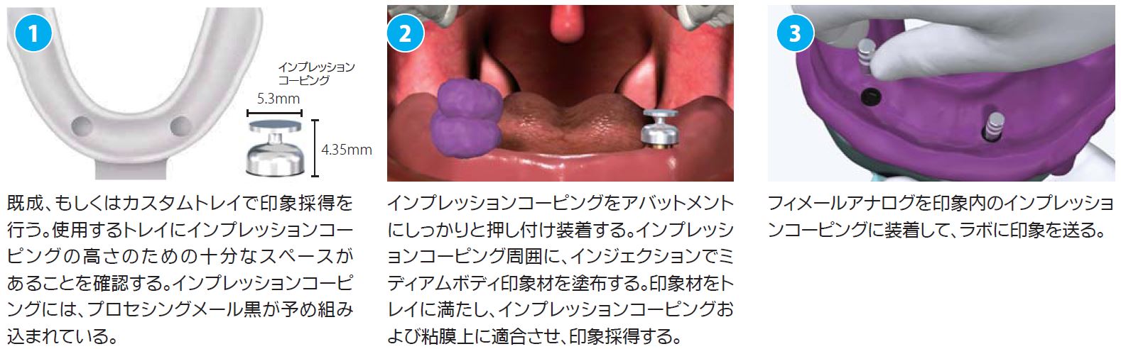 ロケーターアタッチメントシステム|株式会社インプラテックス