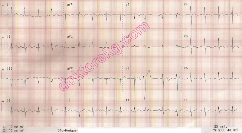 acute anterior myocardial infarction - akut ön duvar miyokard