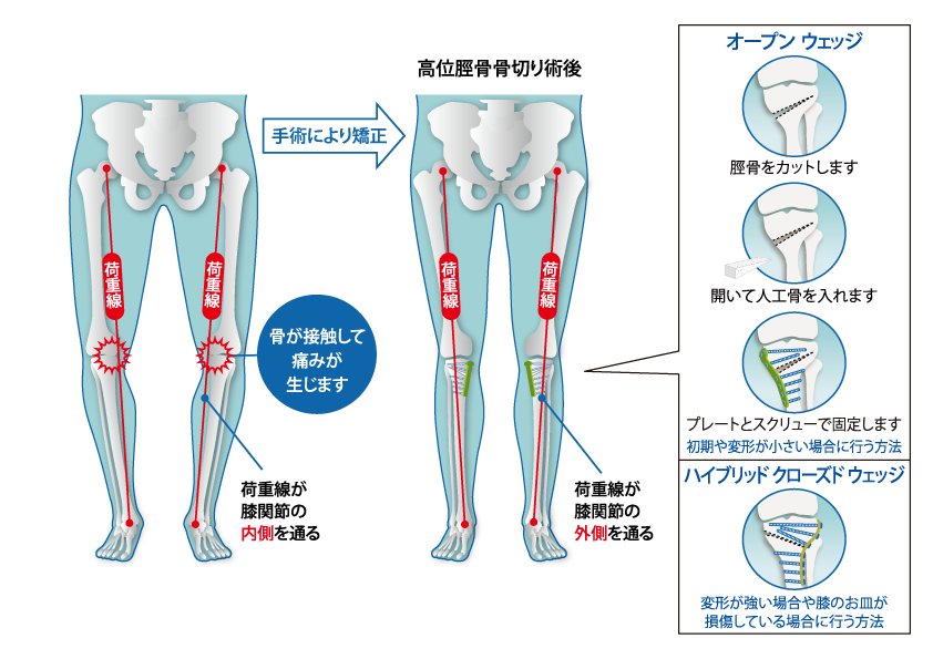 膝周囲骨切り術について | 診療科・部門 | 済生会横浜市南部病院