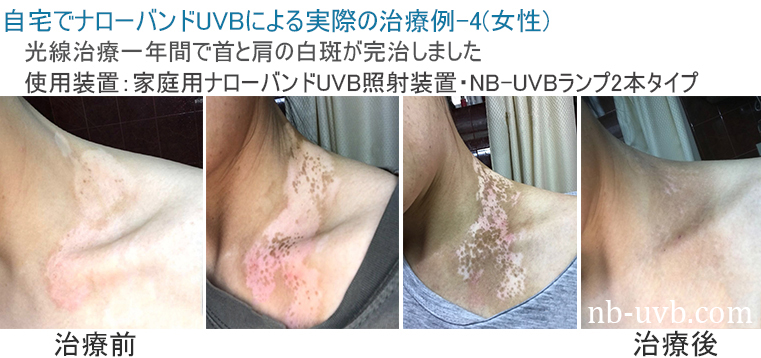 家庭用ナローバンドUVB(311nm)照射装置[個人輸入]｜在宅での(白斑