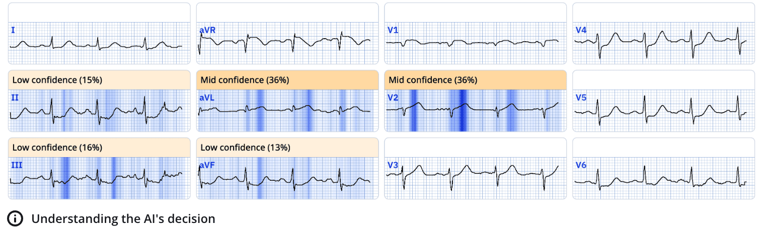 ECG Explainability in PMcardio: Human-Centered AI