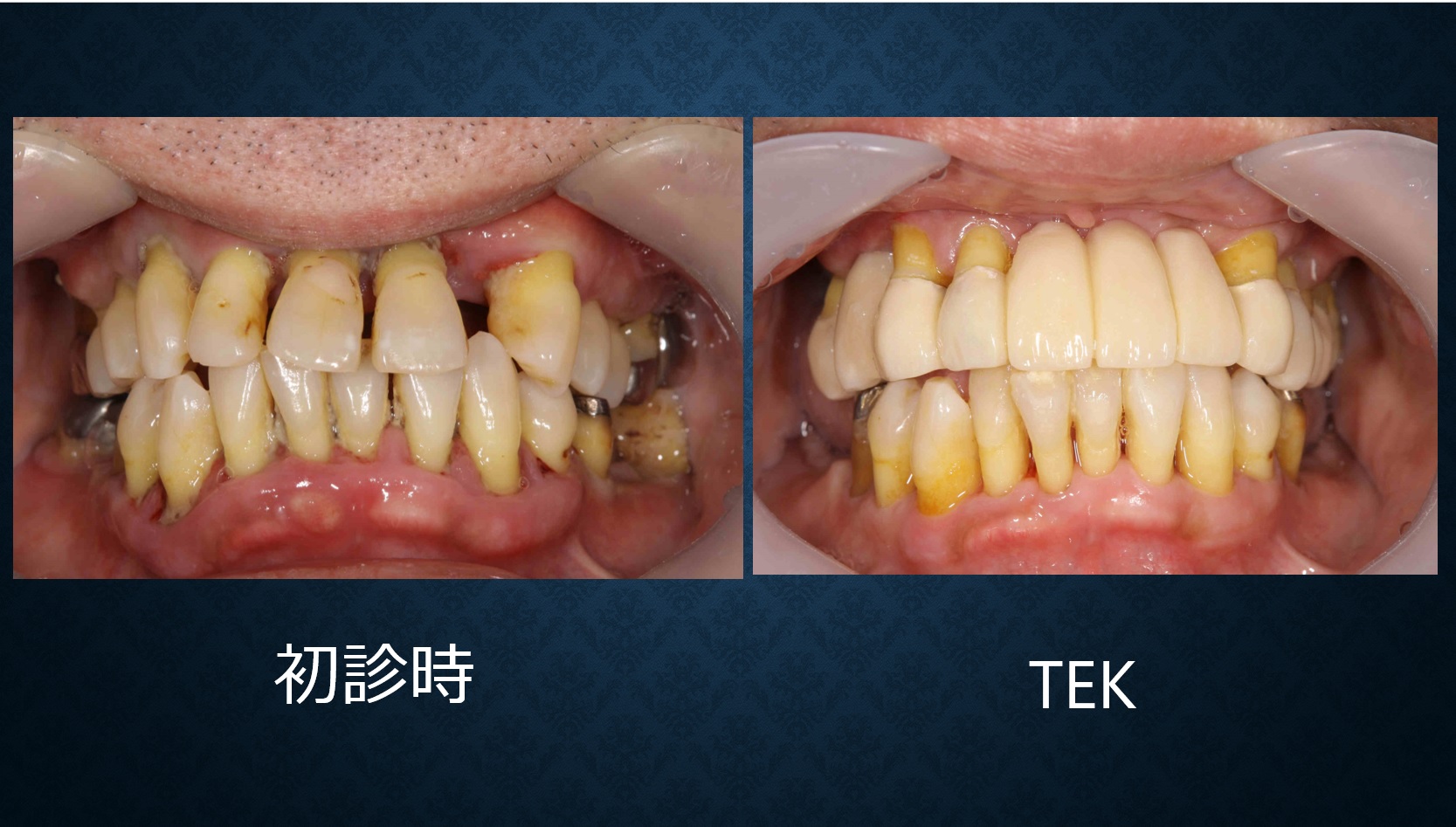 歯周補綴 – TZデンタルクリニック