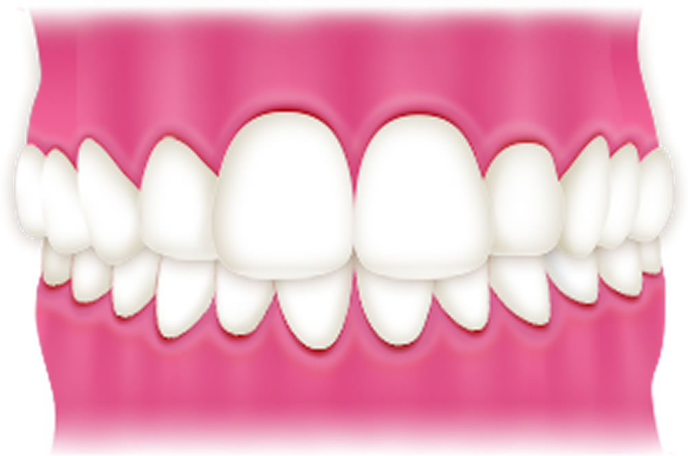 マウスピース型矯正装置インビザライン｜港区麻布十番のUC矯正歯科