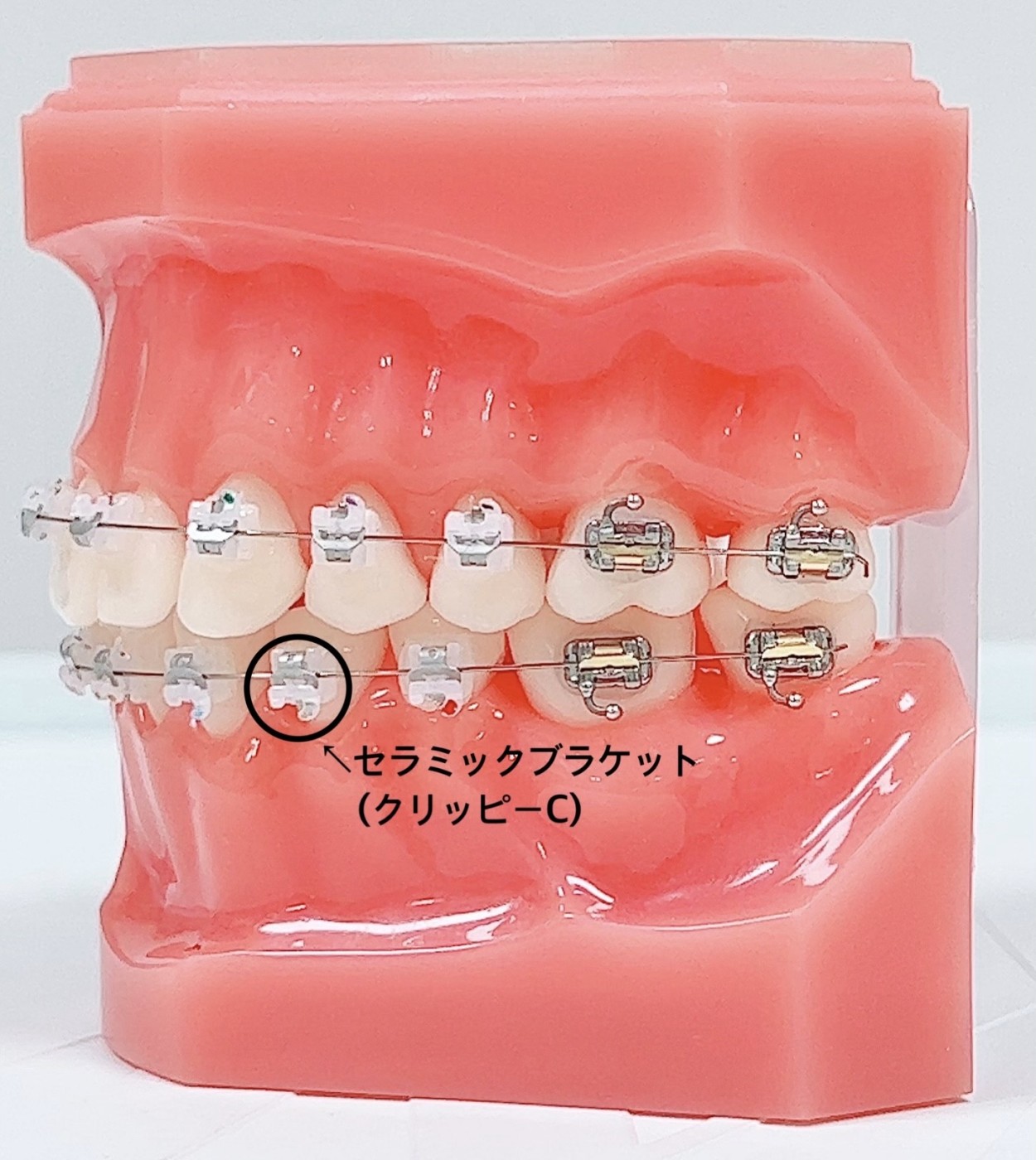 矯正は目立たない時代へ！当院の使用している装置について解説します