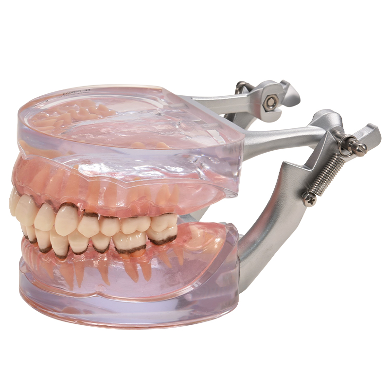 歯周病説明用顎模型 PE-PER004の通販 | Ciモール | Ciモール