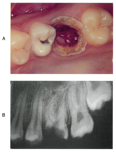 16歳の男子。上顎左側第一大臼歯の痛みを訴えて来院した。1年前からう