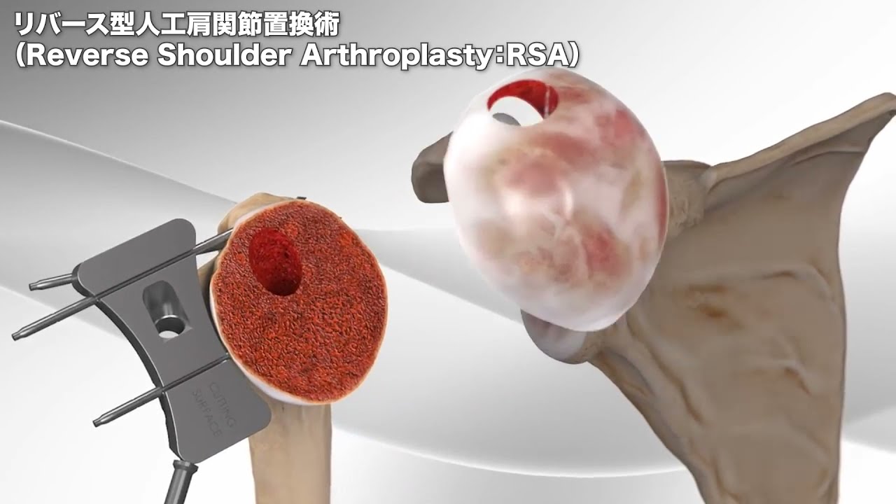 リバース型人工肩関節置換術（肩関節の手術） - YouTube