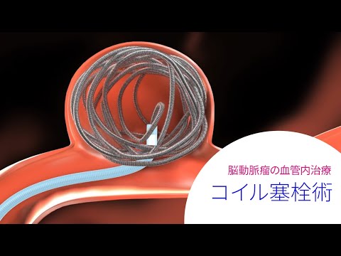 脳動脈瘤の血管内治療 「コイル塞栓術」 - YouTube
