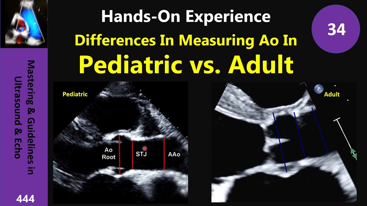 Differences In Measuring Aorta In Pediatric vs. Adult - YouTube