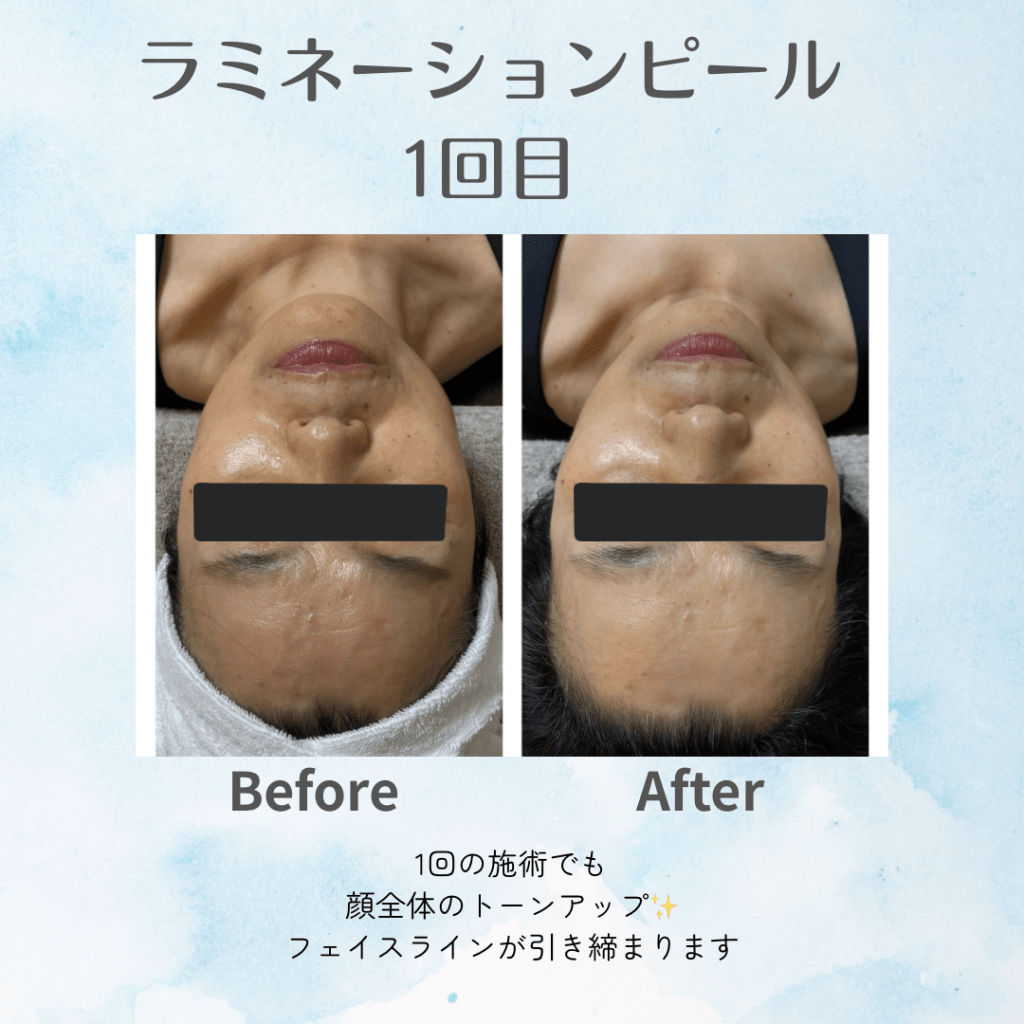 新メニュー】大人の肌育ピーリング：ラミネーションピール