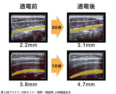 プロテクノPNF | 日本シーエイチシー株式会社