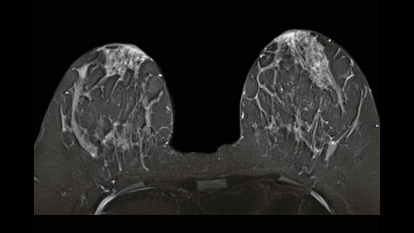 Breast MRI - Siemens Healthineers