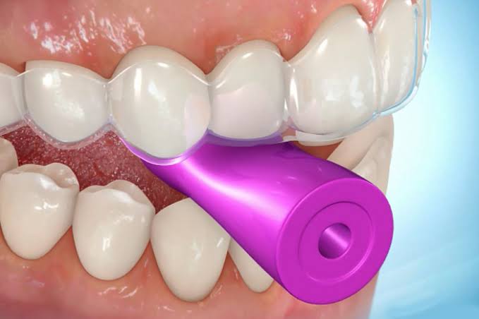 効率的に矯正治療！】振動型の矯正治療効果促進装置について【スマイル