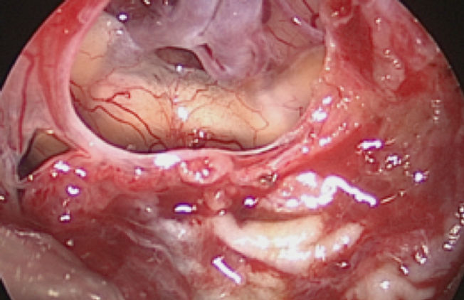 経蝶形骨腫瘍摘出術（ハーディー手術） | 東京 | 虎の門病院 間脳下